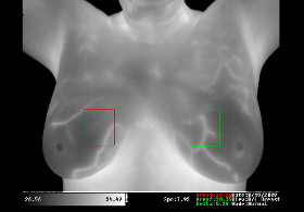 Thermographie Brust