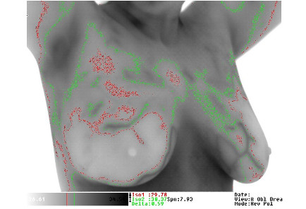 Thermographie Brust